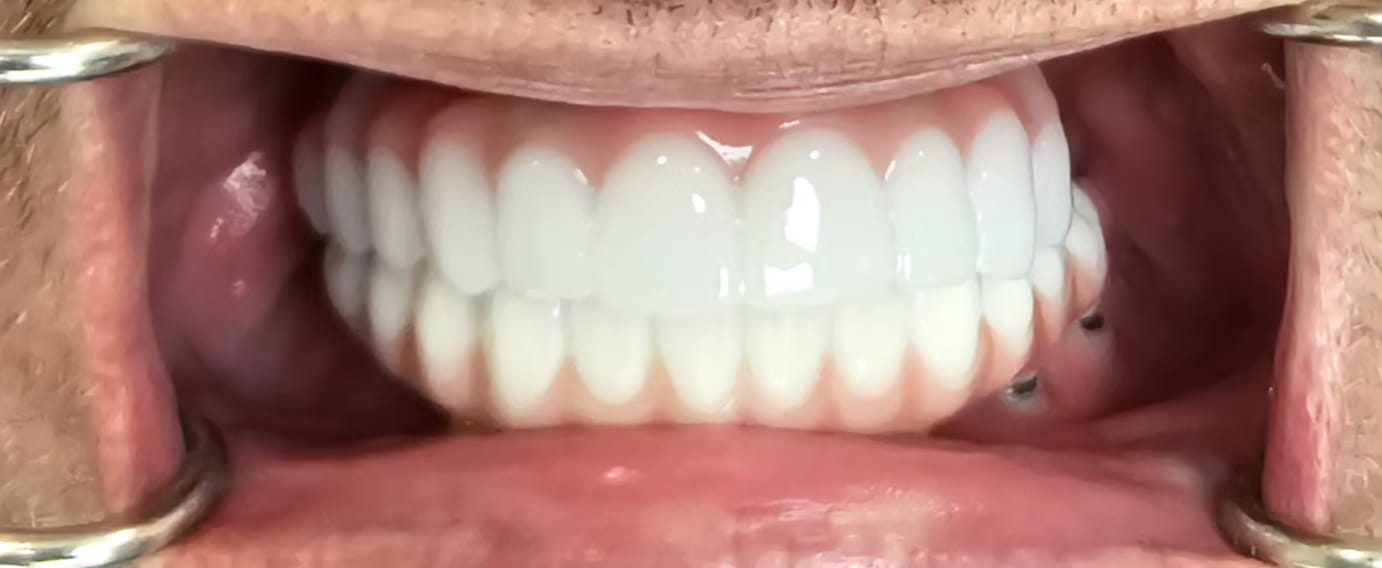Full arch zirconia bridges result view one